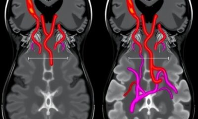 AI model detects lymphovascular invasion in breast cancer MRI scans