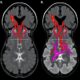 AI model detects lymphovascular invasion in breast cancer MRI scans