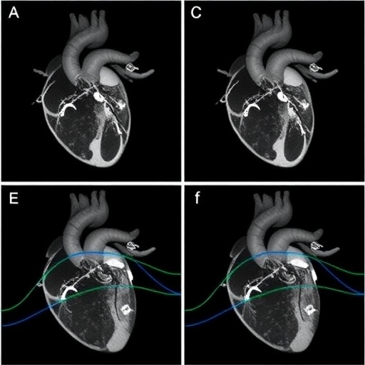 Echocardiographic changes and vascular dysfunction in male and female Fabry patients
