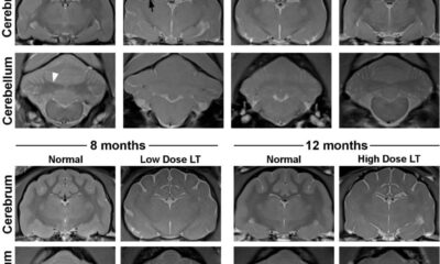 Gene Therapy Extends Lifespan and Reduces Symptoms in Sandhoff Disease Cat Model