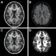 MRI-Negative Temporal Lobe Epilepsy Reveals Distinct Patient Phenotypes