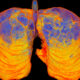 STAT+: AstraZeneca’s experimental COPD treatment posts strong results in late-stage studies