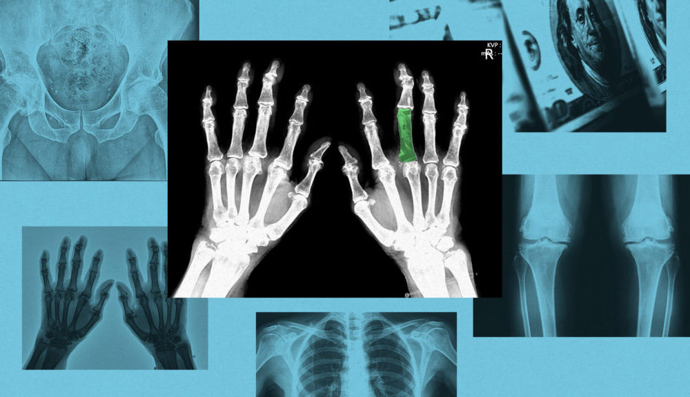 STAT+: Drugmakers, biotech VCs show ‘reinvigorated’ interest in osteoporosis treatments