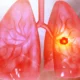 WCLC ‘26: A new ‘ADC era,’ China questions and AstraZeneca’s spotlight