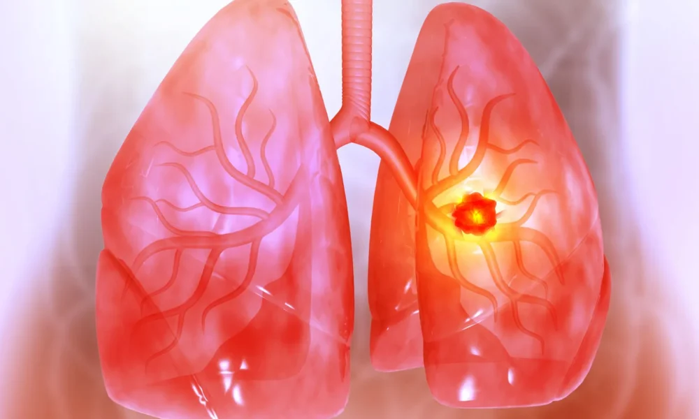 ArriVent collapses on disappointing lung cancer data
