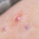 STAT+: AbbVie skin disorder drug succeeds in late-stage trial, but results miss market expectations 