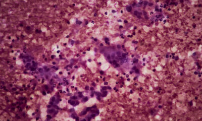 STAT+: Tango reports 82% tumor response rate in trial of combo therapy for advanced pancreatic cancer